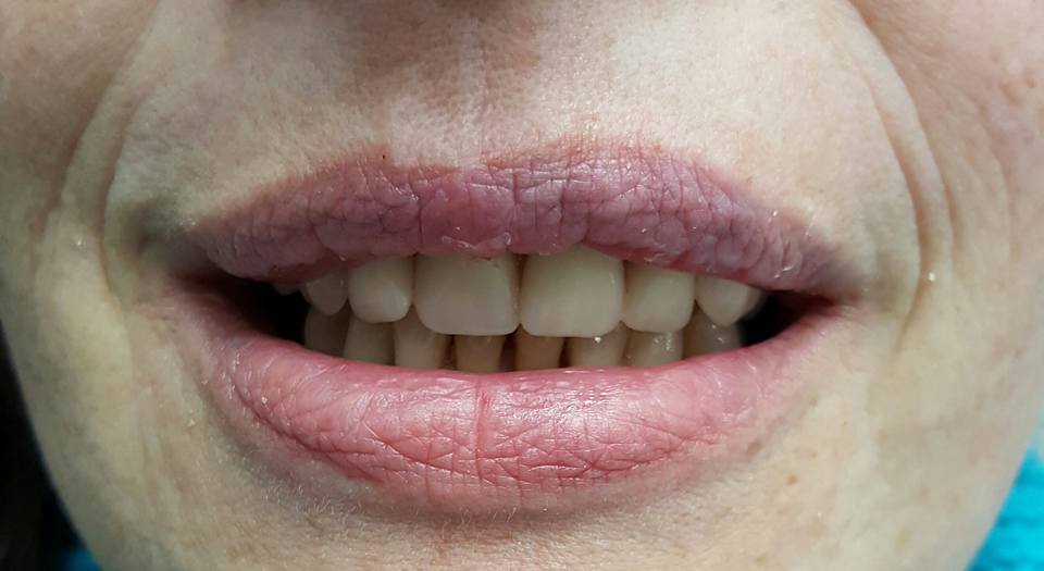Tænder efter samarbejde med klinisk tandteknikker