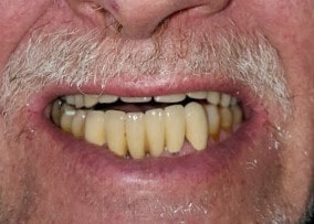 Et billede inden samarbejdet med klinisk tandteknikker blev igangsat