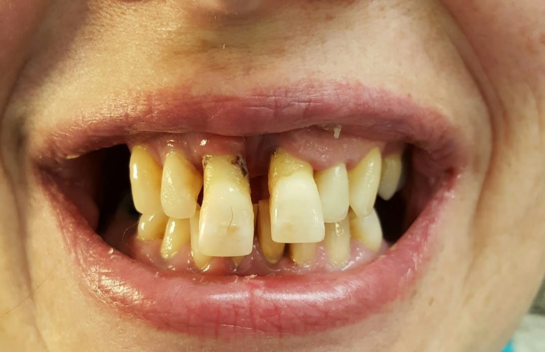 Før klinisk tandteknikker har arbejdet med tænderne