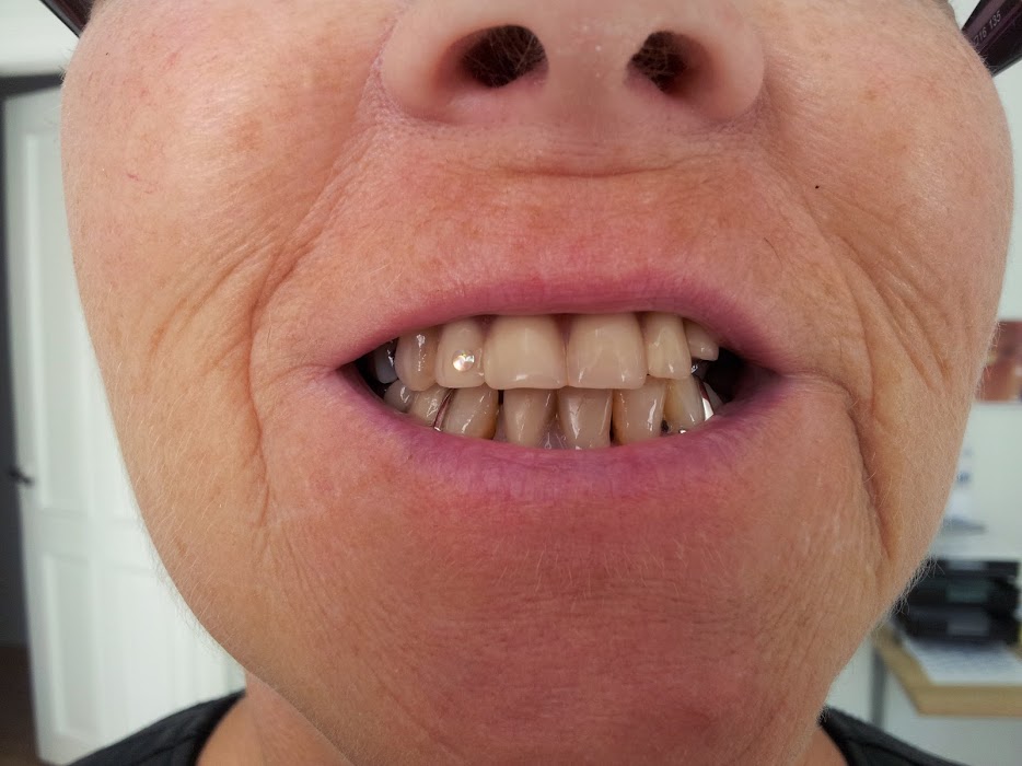 Parodontose arbejde hos klinisk tandteknikker