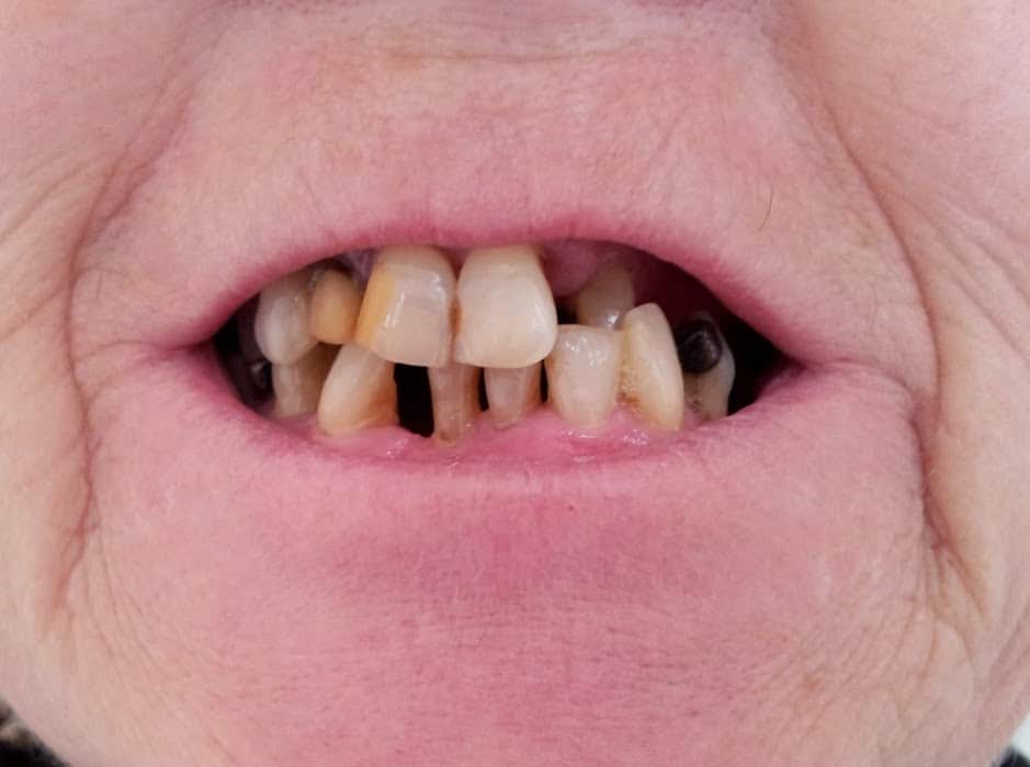Arbejde med parodontose hos klinisk tandteknikker