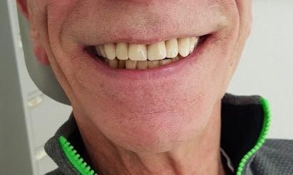 Tænder efter samarbejde med klinisk tandtekniker
