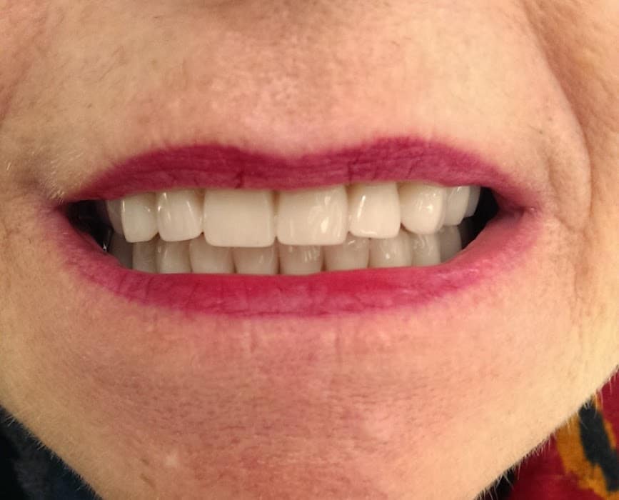 Et billede af en kunde efter tandprotese